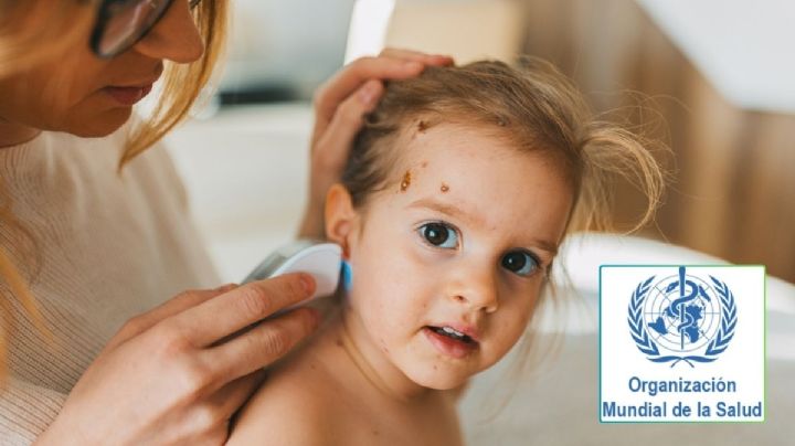 Mpox en México: La OMS responde a todas las preguntas sobre la viruela del mono; síntomas, contagios, vacunas y más