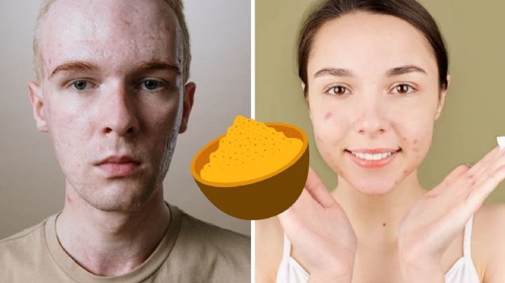 El ingrediente natural que te ayudará a combatir el acné